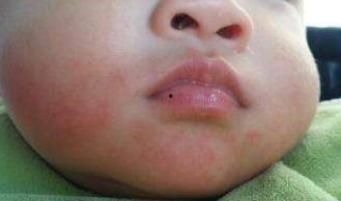 小孩吃瓜嘴巴周边红肿